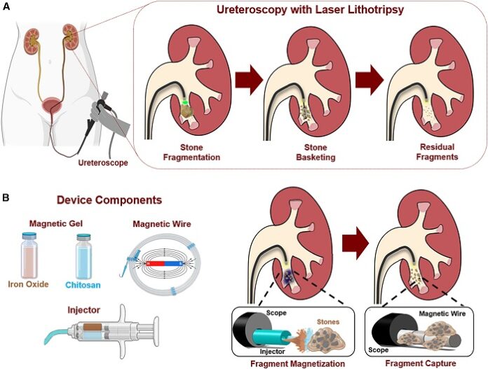 Stanford Develops Magnetic Device to Retrieve Kidney Stones More Efficiently stanford-develops-magnetic-device-to-retrieve-kidney-stones-more-efficiently