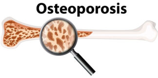 aiims-study-reveals-gut-immune-link-osteoporosis