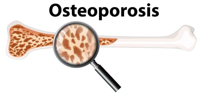 AIIMS Study Reveals Gut-Immune Link Osteoporosis aiims-study-reveals-gut-immune-link-osteoporosis