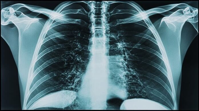 Nadda Calls for Mission-Mode Healthcare Reforms and TB-Free India by 2027 nadda-calls-for-mission-mode-healthcare-reforms-and-tb-free-india-by-2027