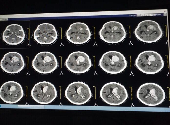 Stroke Prevention and Early Action Protect Your Brain and Mobility