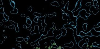 study-reveals-lecanemab-clears-amyloid-plaques-in-alzheimers
