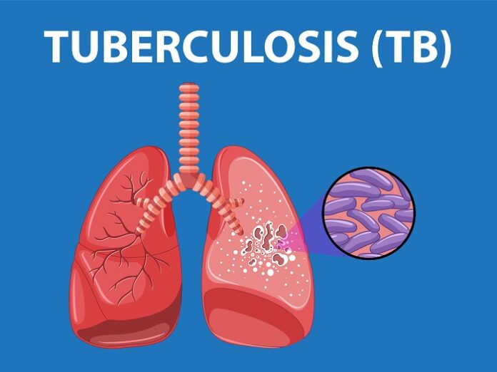 Why TB Persists as Scientists Identify Secret Shield why-tb-persists-as-scientists-identify-secret-shield