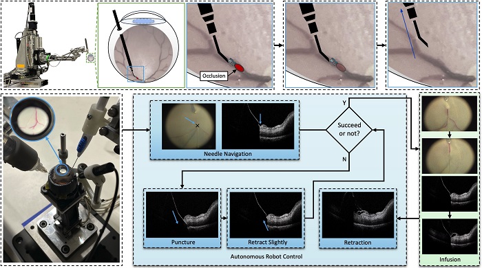 Deep Learning–Guided Robotics Advance Retinal Microsurgery