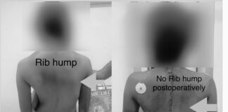 kims-hospital-corrects-severe-s-shaped-spinal-deformity-in-teenager