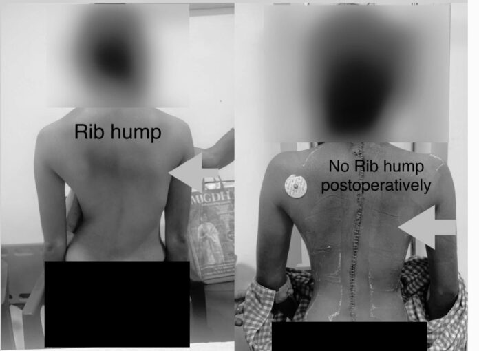 KIMS Hospital Corrects Severe S-Shaped Spinal Deformity in Teenager kims-hospital-corrects-severe-s-shaped-spinal-deformity-in-teenager