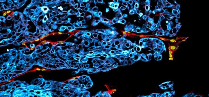New Biomarker in Oral Cancer May Help Detect High-Risk Patients Early