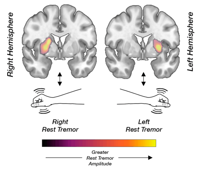 Study Reveals Distinct Brain Mechanism Behind Parkinson’s Tremor