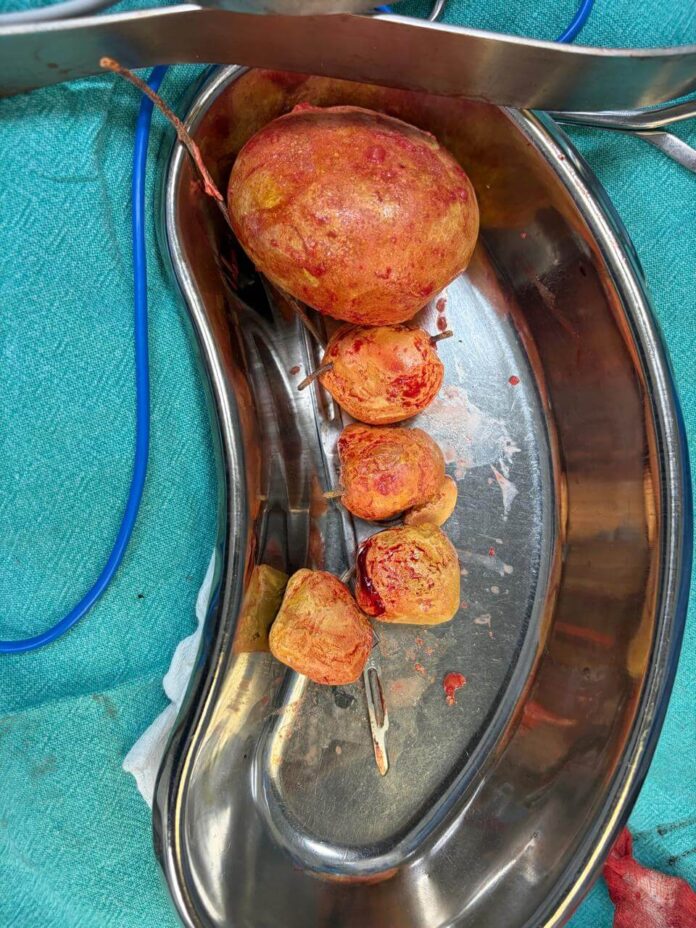 Doctors Remove 600g Giant Bladder Stone in Complex Surgery at AINU (1)