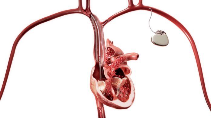 Philips Launches Next-Generation Occlusion Balloon for Cardiac Emergencies (1)