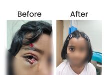 KIMS Hospitals Restores Six-Year-Old’s Vision Function After Complex Eyelid Surgery