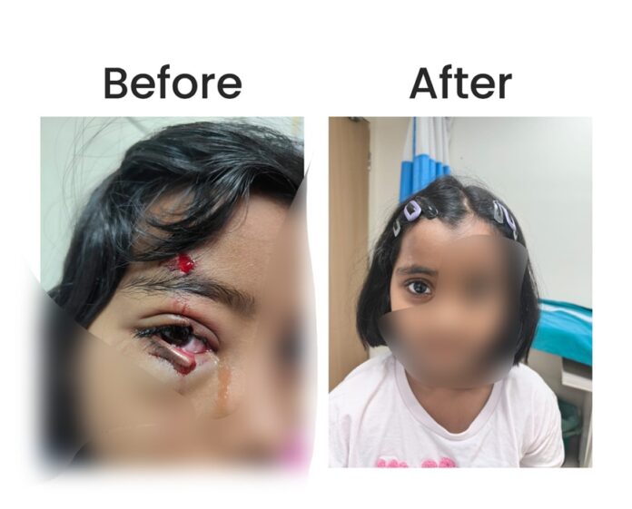 KIMS Hospitals Restores Six-Year-Old’s Vision Function After Complex Eyelid Surgery
