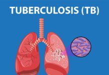 Drug-Resistant TB Can Escape Standard Testing