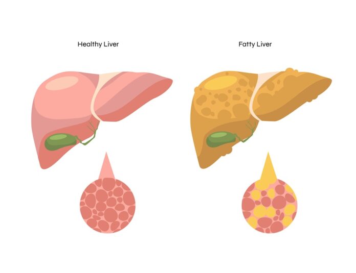Fatty Liver Emerges as India_s Fastest-Growing Liver Health Threat, Warn AIIMS Experts