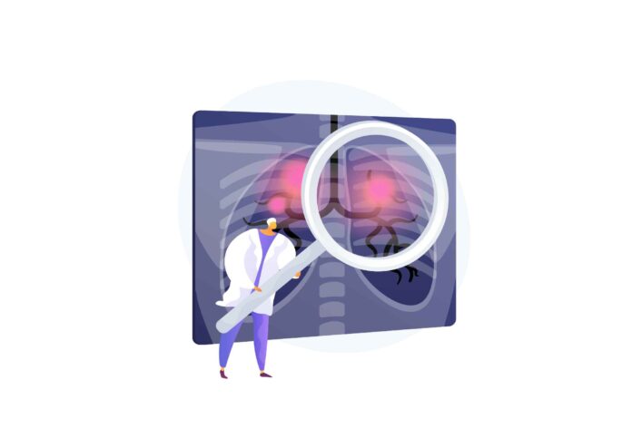 Study Identifies Genetic Risk Factor for Lung Cancer in Never-Smokers