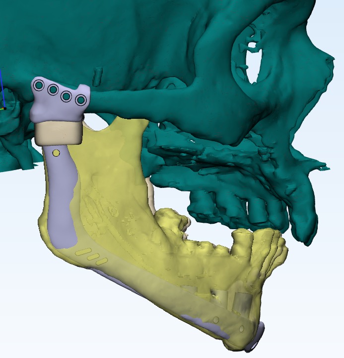 Cancer Survivor Receives 3D-Designed Titanium Jaw Implant to Restore Facial Structure